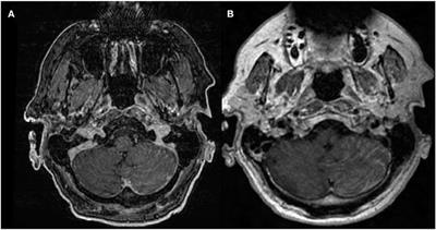 Advanced Imaging of Brain Metastases: From Augmenting Visualization and Improving Diagnosis to Evaluating Treatment Response